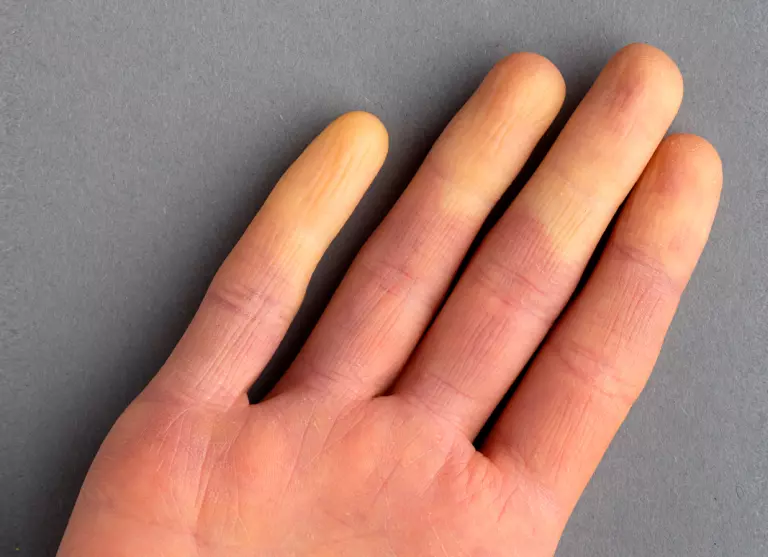Fenómeno de Raynaud